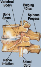Disc Pain Treatment Chicago Disc Pain Treatment Chicago