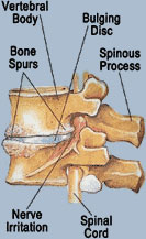 Disc Pain Treatment Chicago