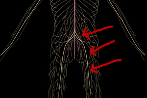 Sciatica Sciatic Treatment - Chicago Chiropractor