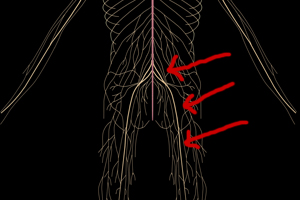 Sciatic Treatment - Chicago Chiropractor