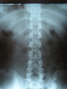 Chiropractic X-Rays 