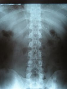 xrays Chiropractic X-Rays