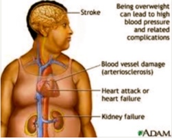Disease associated with Obesity