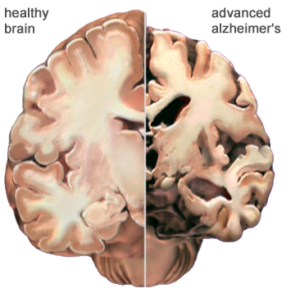 Alzheimers Disease CHICAGO CHIROPRACTOR