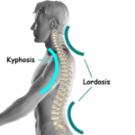 Cervical Kyphosis Chiropractic Treatment - Chicago Chiropractor