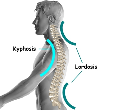 What Is Cervical Kyphosis? Symptoms, Causes, And Treatment