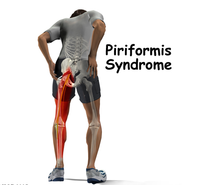 Piriformis Syndrome and Chiropractic Treatment 