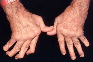 Arthritis Treatment by Chicago Chiropractor